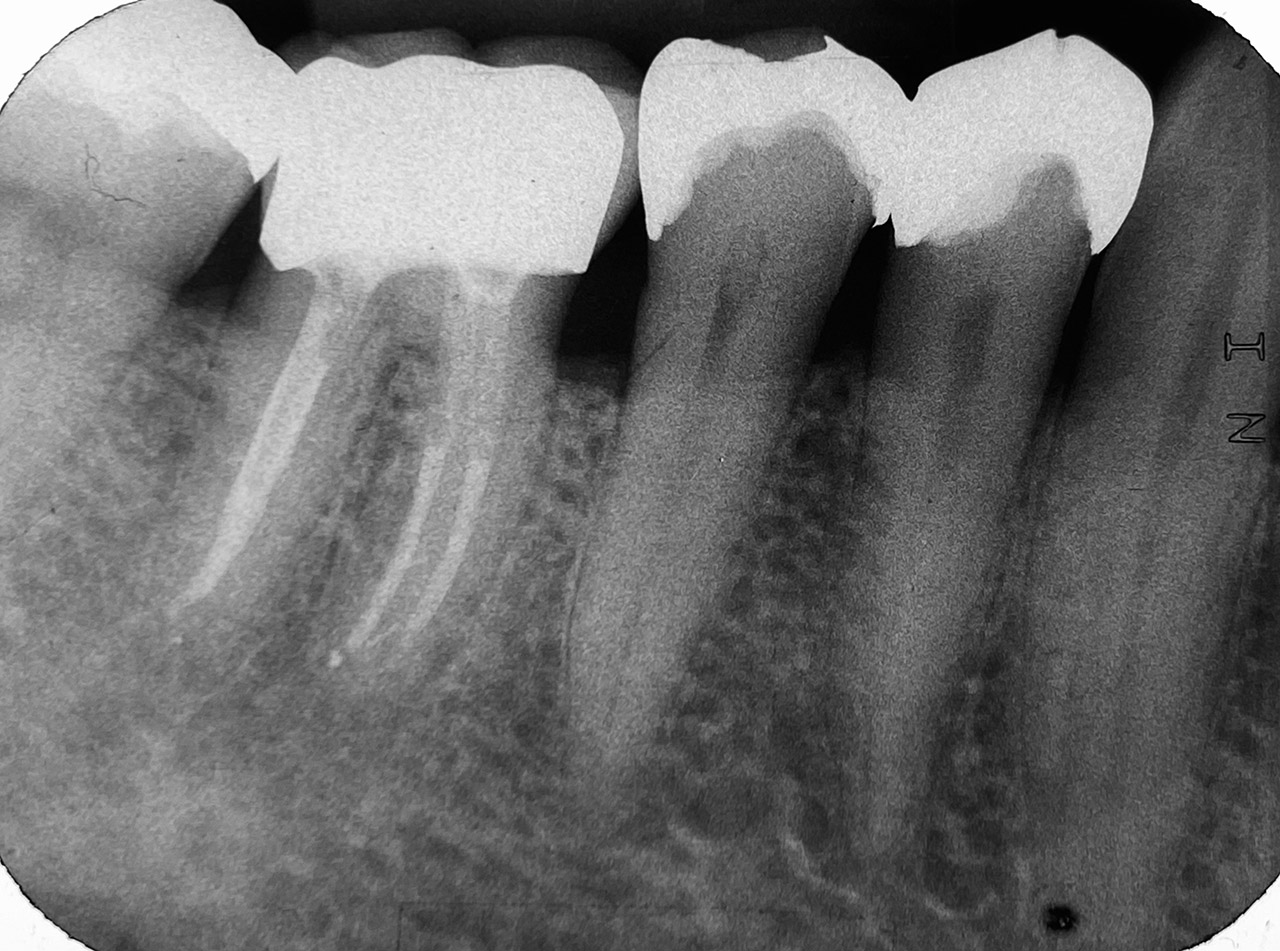 Endodontie/Wurzelbehandlung 03