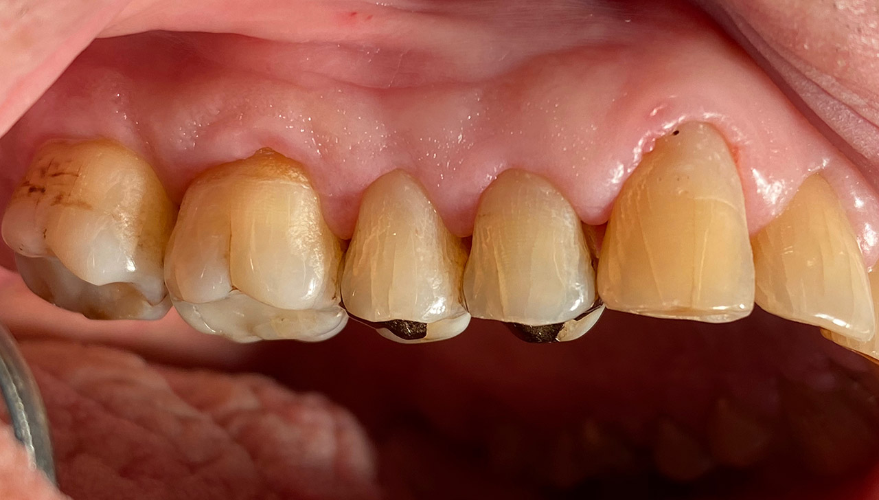 Parodontologie/Gingivahyperplasie 06