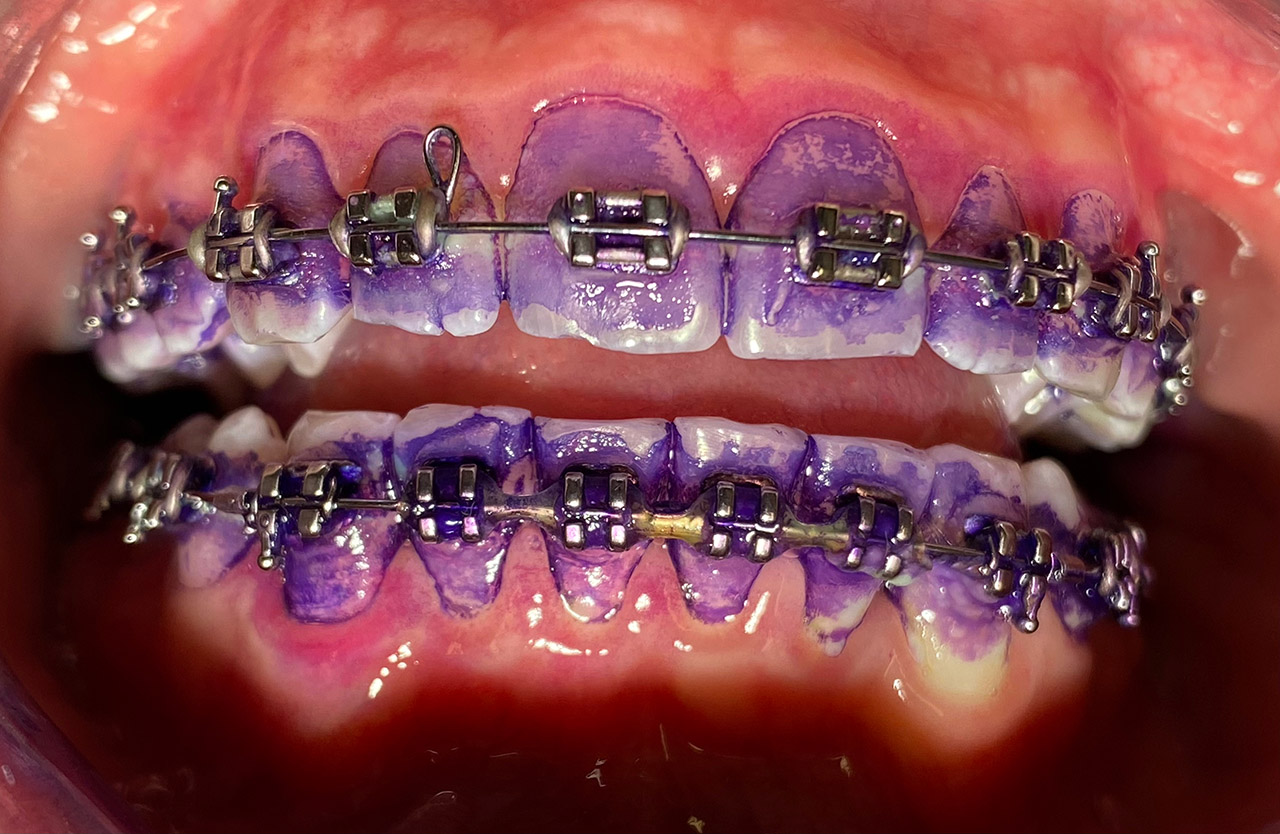 Prophylaxe/professionelle Zahnreinigung 01