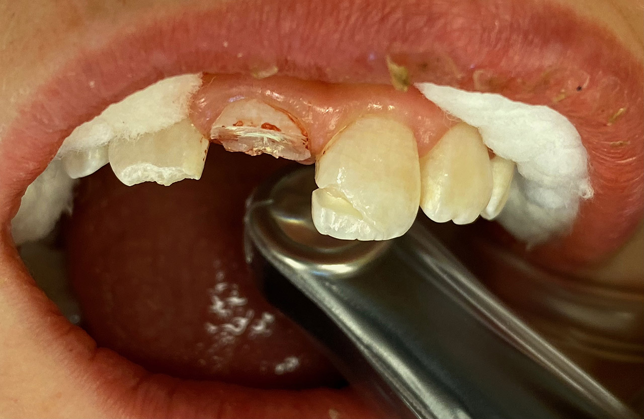 Traumatologie und Endodontie 06