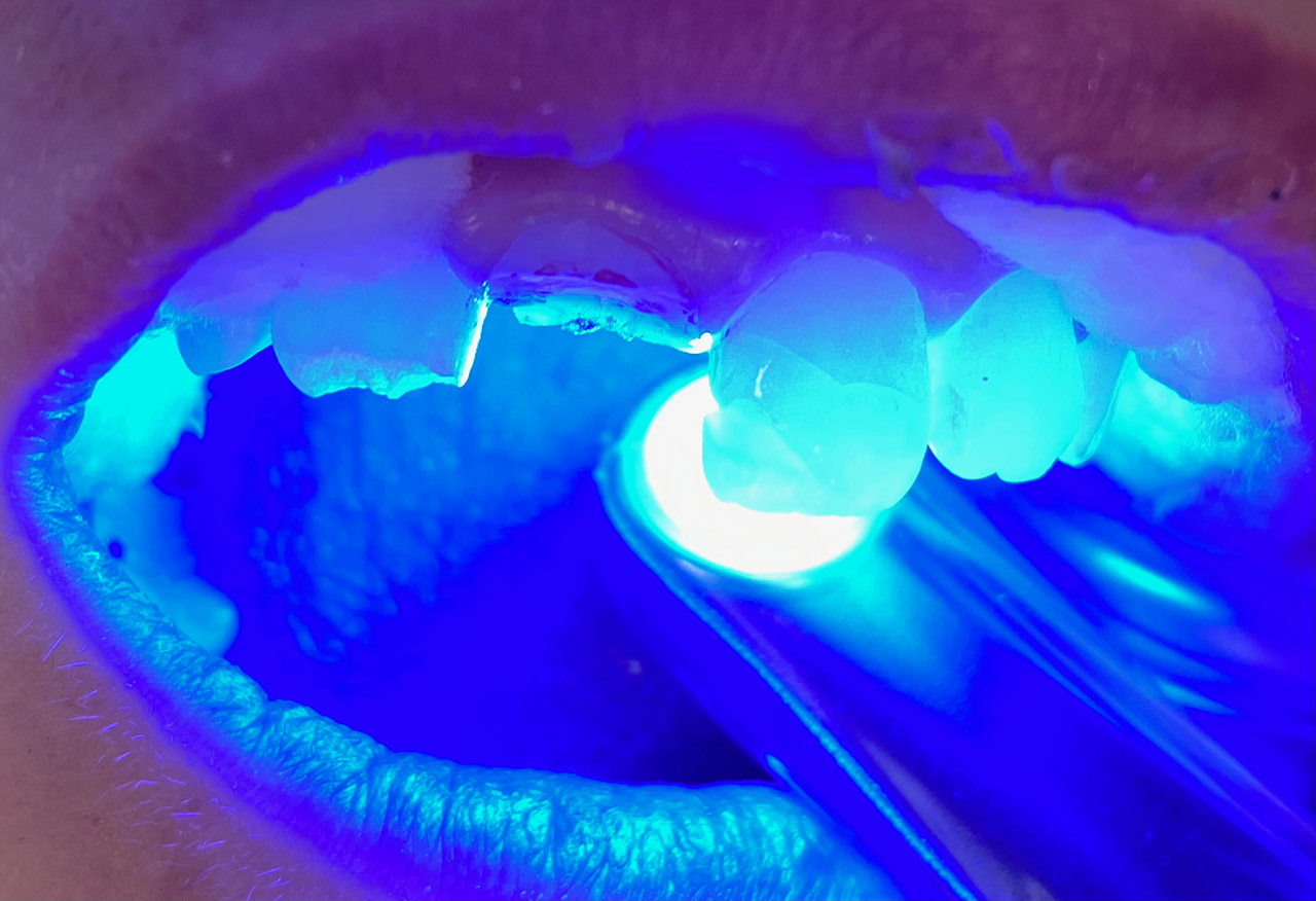 Traumatologie und Endodontie 05